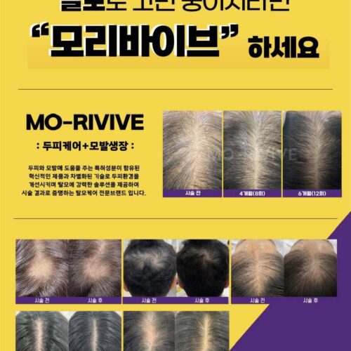 탈모 고민 그만! 탈모 탈출, "모리바이브"와 함께!