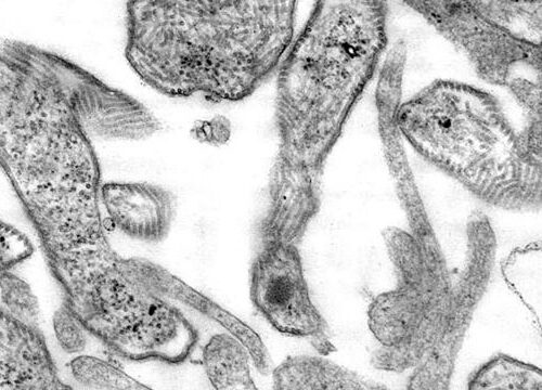 어번(Auburn) 교육구, 유행성 이하선염 예방접종 맞지 않은 아이들은